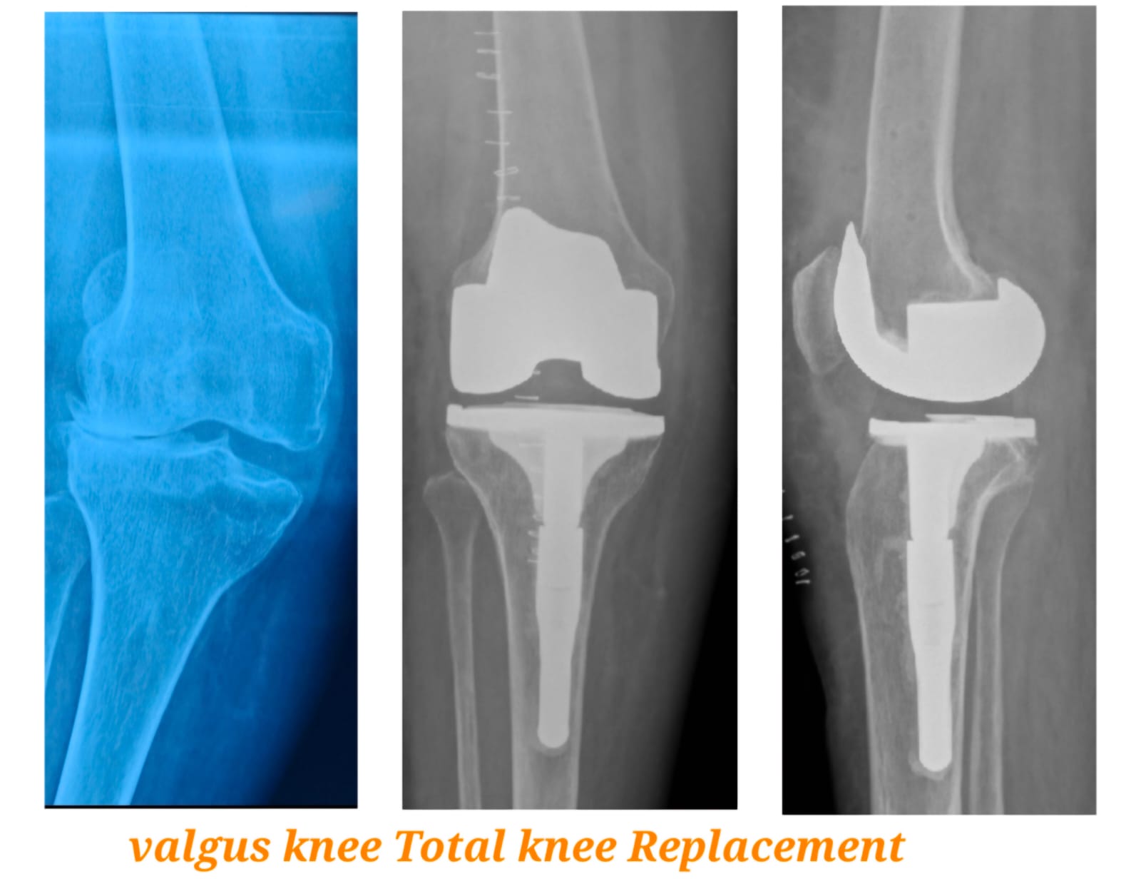 Knee X-ray 3